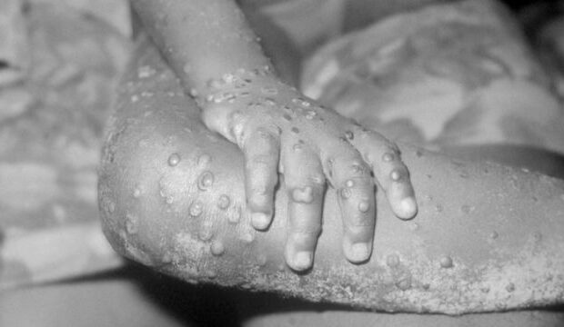 image-1653382583__103585163_monkeypox-getty