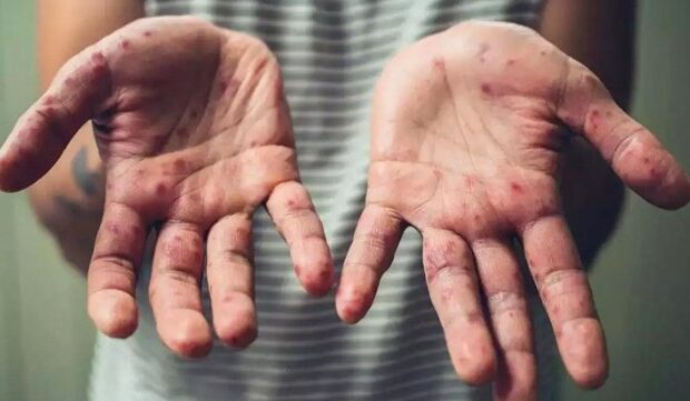 image-1654758259_yunanistanda-ilk-maymun-cicegi-vakasi