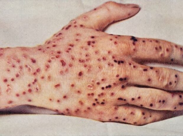 image-1653049320-cicek-hastaligi-nedir-belirtileri-neler-h1578669582-c2de4b