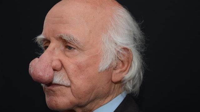 image-1660199578_84-yasindaki-hastanin-burnundan-100-gramlik-kitle-15159258_3305_o