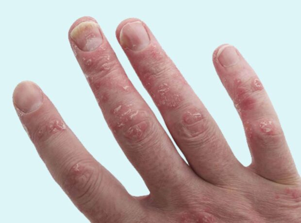 image-1694759109-eczema-1